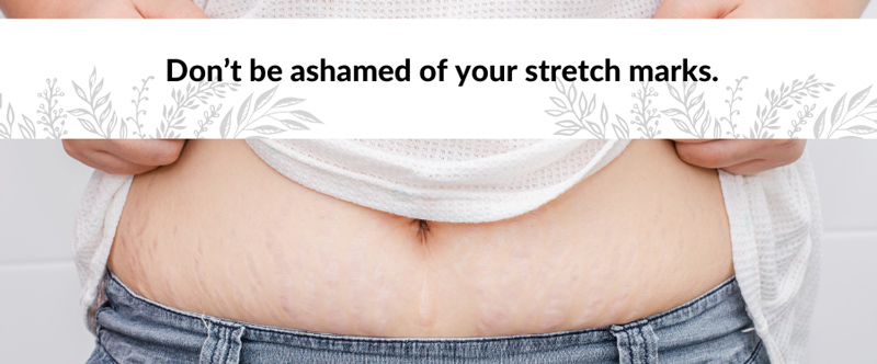 dont be ashamed of your stretch marks